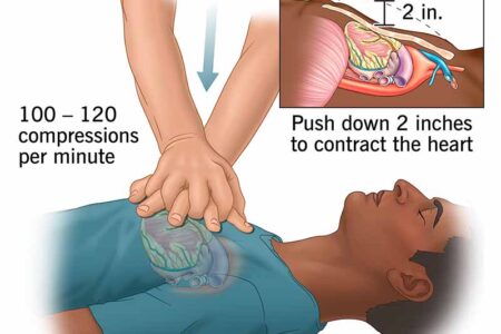 Teknik CPR Darurat Henti Jantung