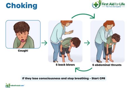 Cara Tangani Anak Tersedak Benda asing dengan cepat
